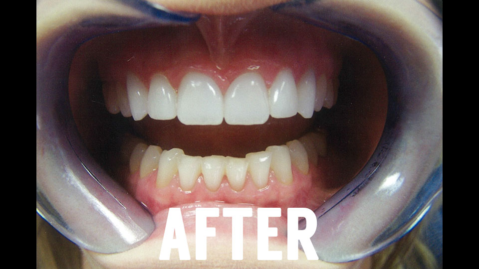 After Dental Veneers