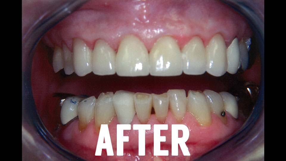 After Dental Crowns