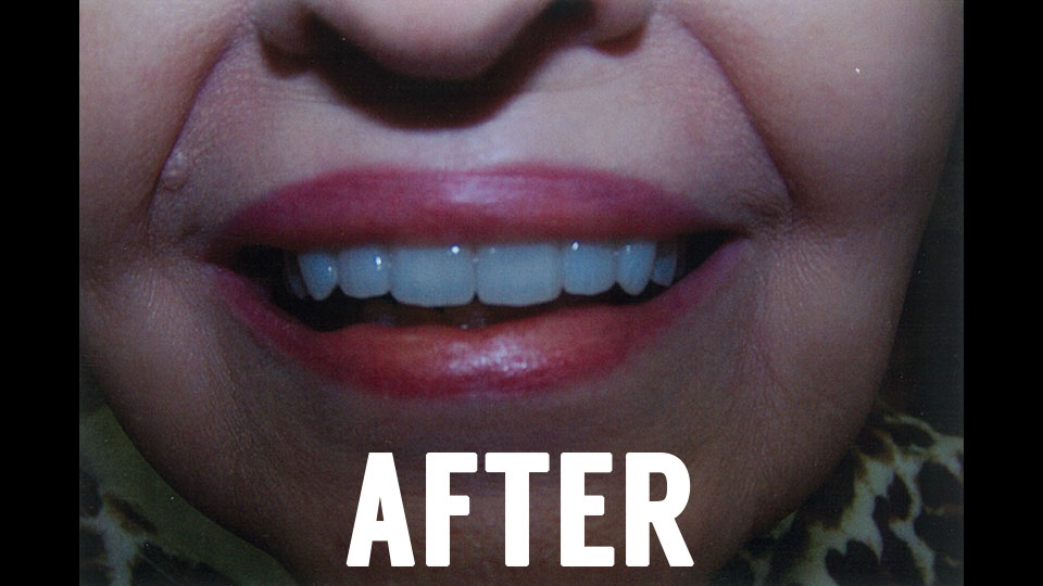 Dental Veneers After Picture