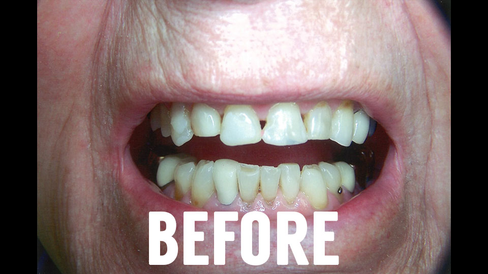 Before Dental Crown