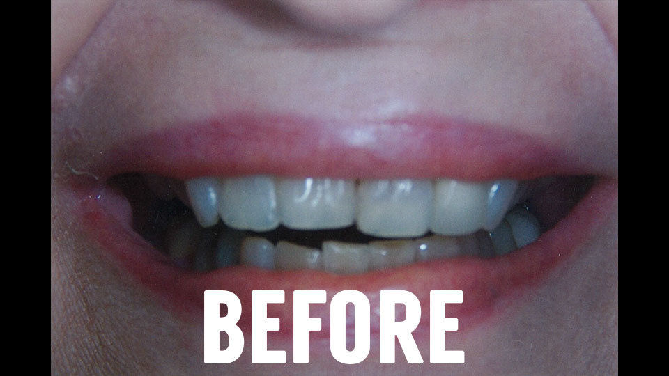 Dental Veneers Before Picture