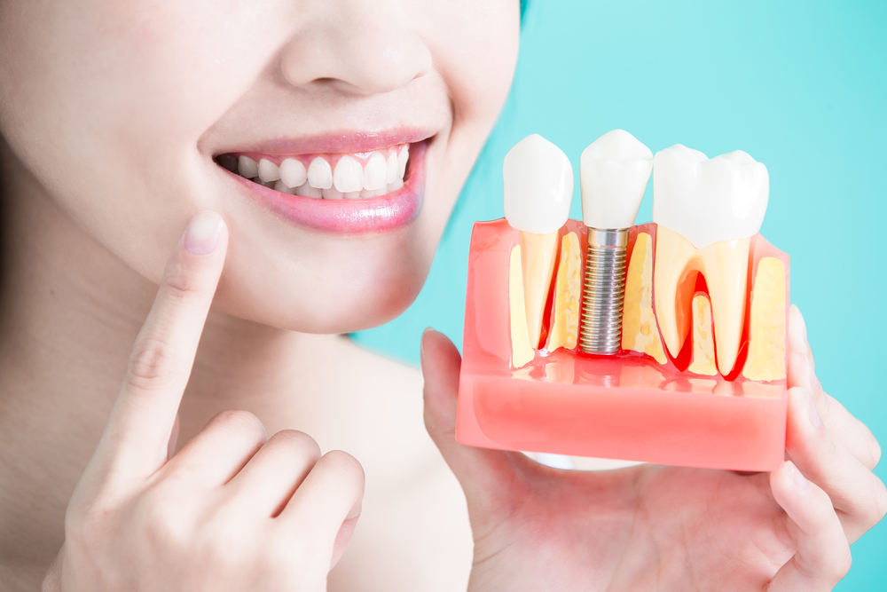 Benefits of Dental Implant Healing Cap: Restore Dental Implants