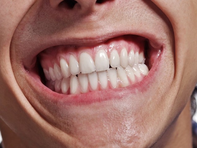bruxism or teeth grinding