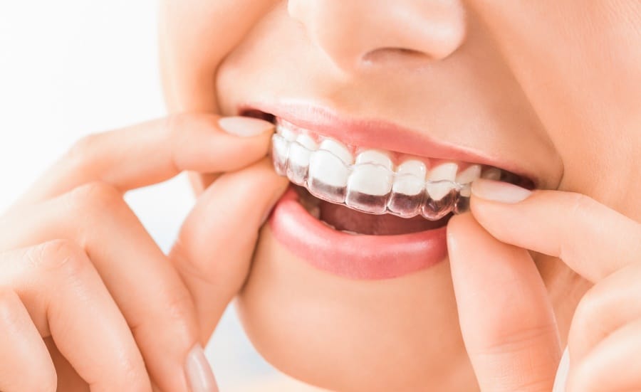 Mouthguard for Teeth grinding