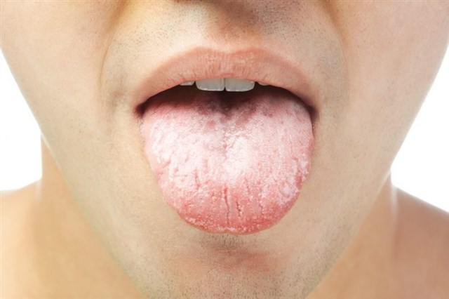 Dry Mouth (Xerostomia)