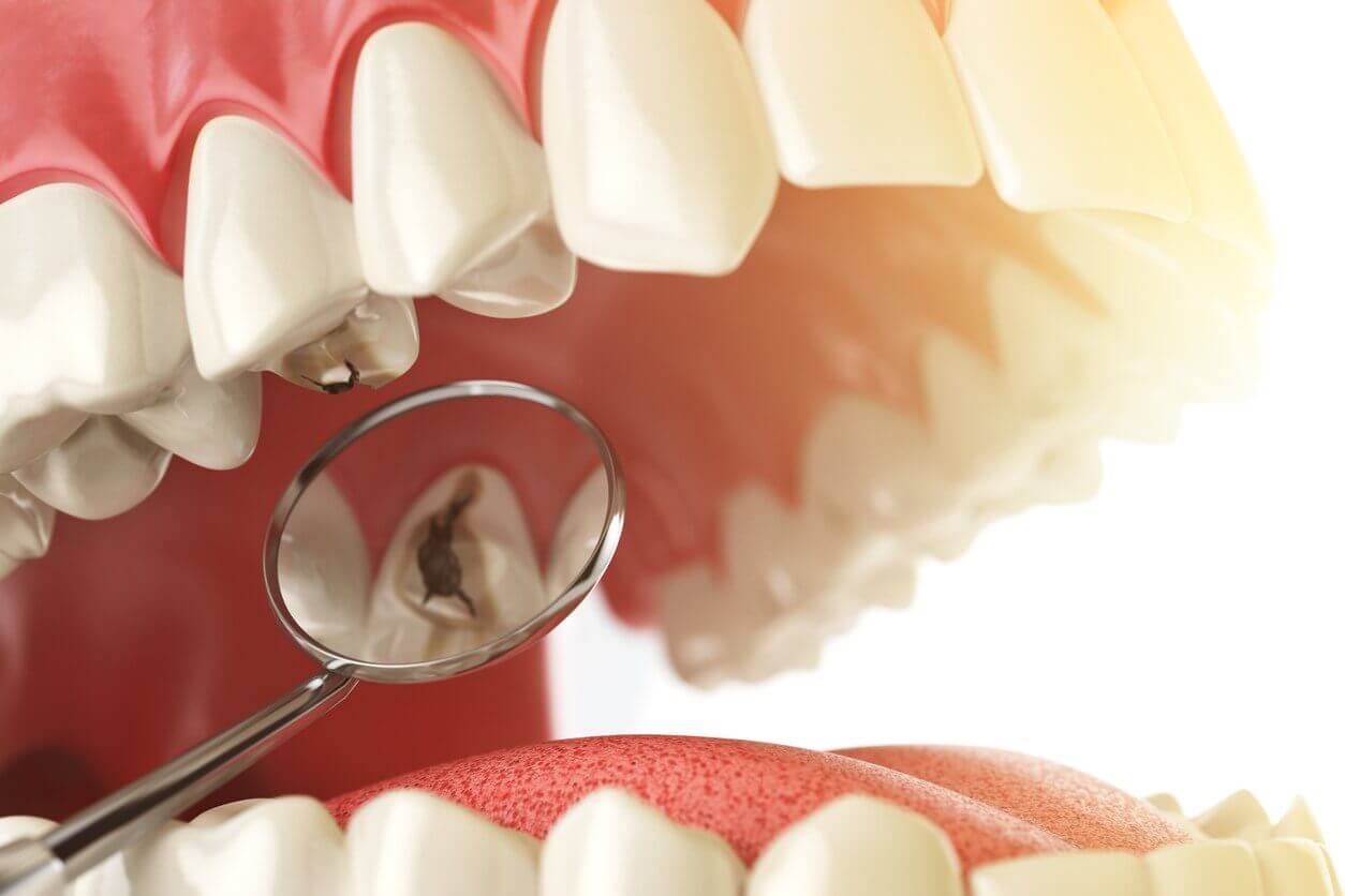 What are Dental Sealants & How Dental Sealants Procedure Work