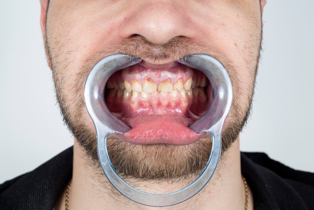 https://www.fitzgeralddentistry.com/wp-content/uploads/2021/09/plaque-on-teeth-tartar.jpg