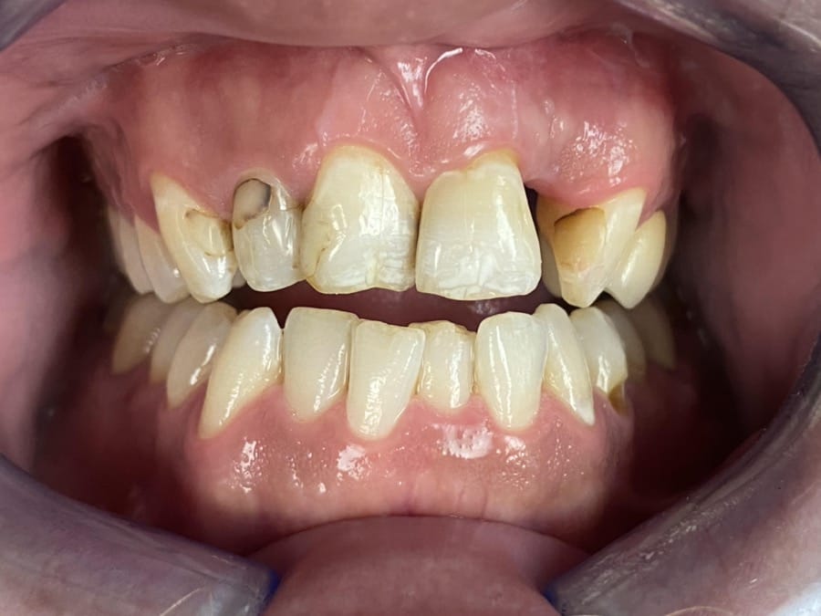 Before image of Dental Cavities