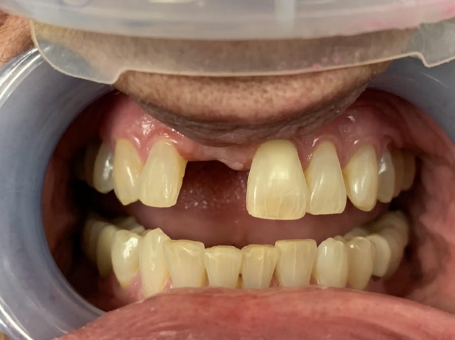 Before image of missing teeth