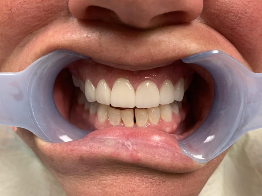 Root Canal After Pictures