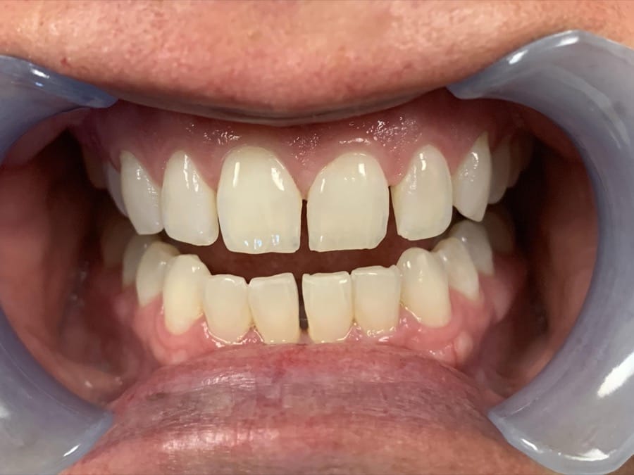 Root Canal Before Pictures