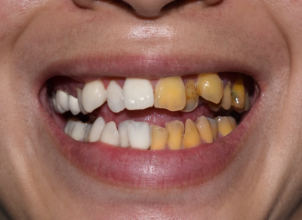 tooth-discoloration-causes-treatment.jpg
