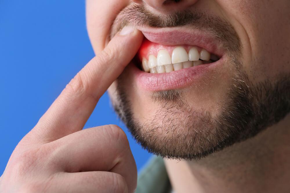 Gum Disease Gingivitis and Periodontitis