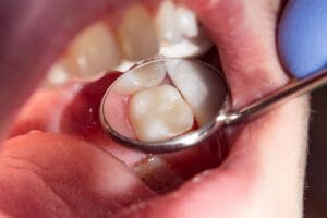 Composite Fillings Murfreesboro TN